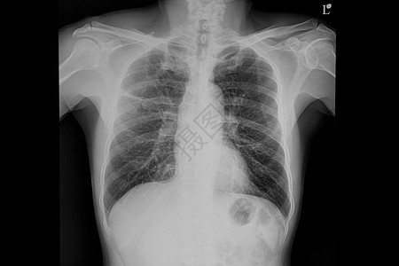 一名肺炎病人的胸前X光片图片