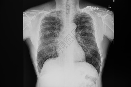 一名骨折锁颈骨病人的胸部X光片图片