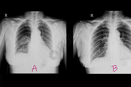 一名肺炎球菌患者的胸部X光片图片
