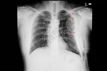 一名肋骨多处骨折病人的X光胸部膜图片