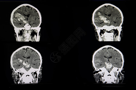 对急性出血性中风的病人进行CT扫描射线x射线手术中风情况出血治疗紧迫感医生高血压图片