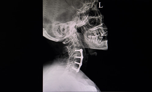 对一个有板和螺丝固定的病人颈部的X光胶片图片
