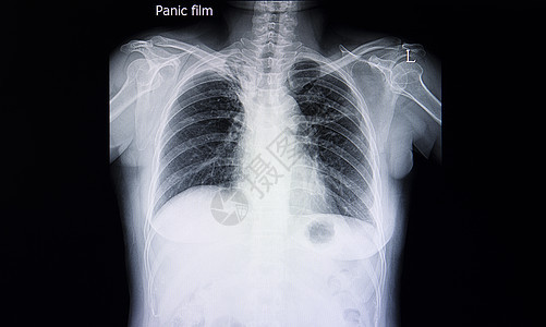 一名肺结核患者的胸前X光片病理医生身体医院骨骼病变射线电影x光扫描图片
