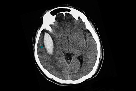 CT扫描脑大腹内出血的CT扫描背景图片
