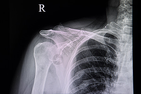 一名有旧肋骨骨折的病人的胸部X光片图片