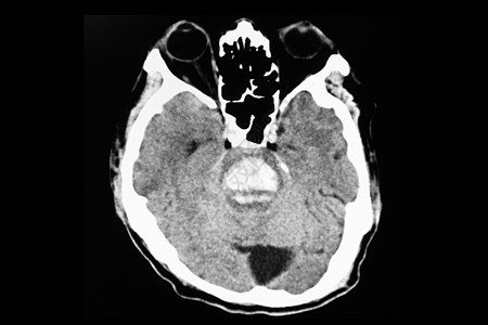brian干干出血CT扫描图片