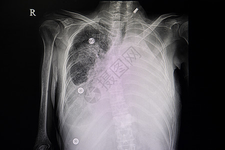 肺部转移性肿瘤癌症诊断x射线积液药品x光骨骼医生放射科疾病图片