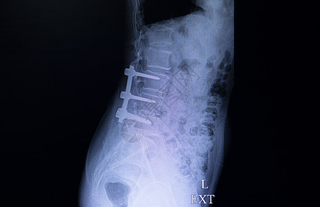 乳腺切开术病人背部X光胶片诊断射线考试医生放射科脊柱治疗疾病光盘神经图片