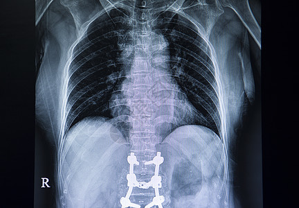 乳腺切开术病人背部X光胶片骨头胸椎事故解剖学脊柱放射科手术医生药品治疗图片