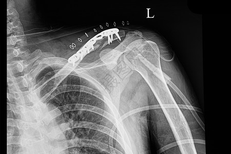 一名骨折锁颈骨的病人的休尔德薄片X光片图片