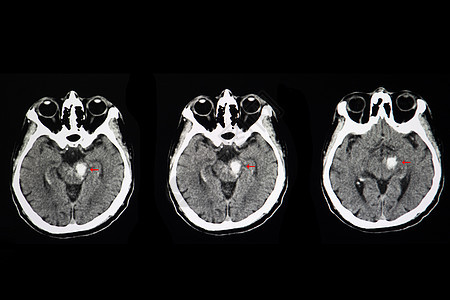 脑干干叶出血射线大脑小脑扫描治疗外科诊断手术医生病人图片
