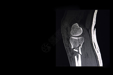 CT膝部扫描图片