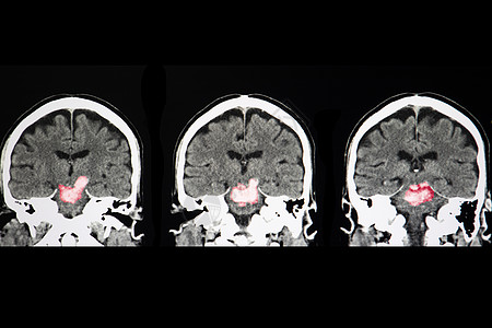 脑干干叶出血外科中风扫描病人药品船只射线疾病小脑医院图片