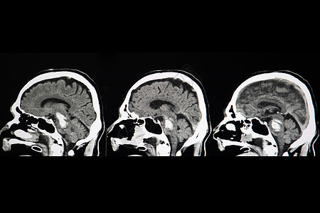 脑干干叶出血解剖学电影中风出血颅骨诊断药品外科断层扫描图片