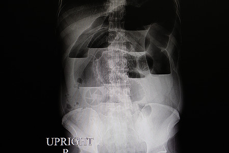 肠道阻塞腹部射线药品x光x射线教育环形白色解剖学骨骼图片