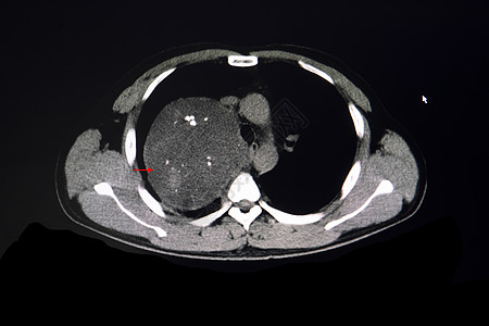 胸部CT扫描显示前中枢肿瘤的胸部图片