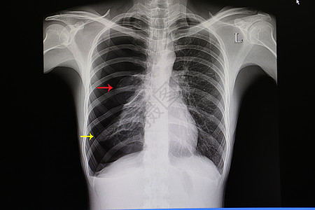 大型肺炎球菌患者胸部薄膜图片
