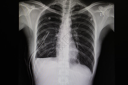 胸部排水的病人图片
