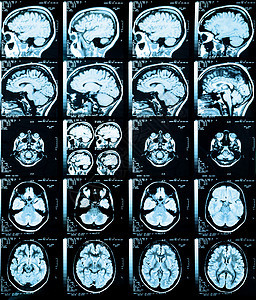脑头痛操作药品放射科血管生活男性医院保健骨头图片