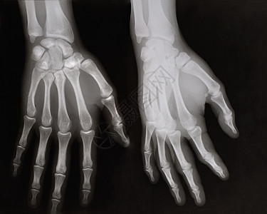 手拍X光片外科医疗黑色卫生关心射线骨骼医生骨头放射科图片