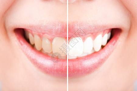 在刷牙之前和之后 缝合的牙齿雌性图片