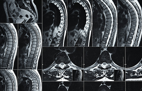 MRI或人体腰脊椎CT扫描图片