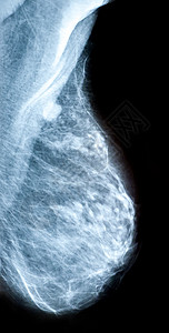 乳腺癌筛查     放射科女性卫生乳房疾病照片射线x射线乳腺摄影保健背景图片
