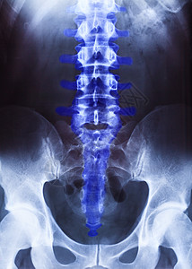 骨盆和脊柱的X光照相诊断椎骨外科躯干电影病人医生骨骼疼痛图片