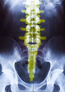 骨盆和脊柱的X光x射线辐射医生诊断成人放射科身体疾病科学照相图片
