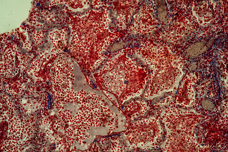 200x 显微镜下的肺组织肺结核组织块茎红色致命腐烂病理结节感染疾病结核筷子图片