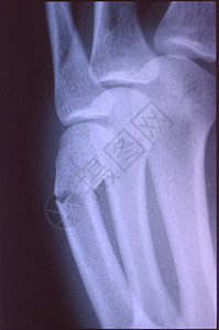 X光图像 男人 手与骨头和关节药品科学指骨医院辐射考试诊断医生x光组织背景图片
