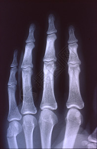 X光图像 男人 手与骨头和关节休息药品医生科学组织指骨事故辐射诊断考试图片