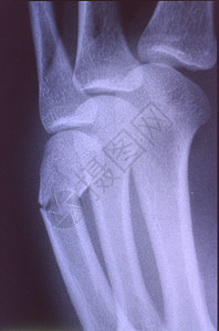 X光图像 男人 手与骨头和关节医院科学休息考试辐射指骨组织事故x光诊断背景图片