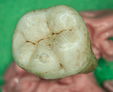 古老的有牙根的人类摩尔齿神经元牙龈研磨补钙棕色神经咀嚼搪瓷白色臼齿图片