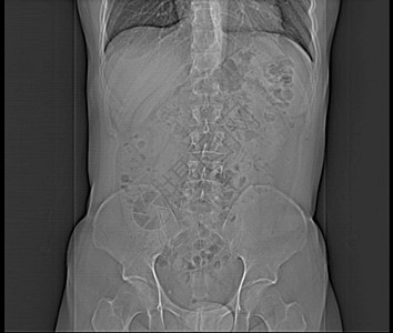 人类腹部人 男人 CT扫描树干x光肋骨纸巾考试射线诊断内脏脊柱骨盆图片