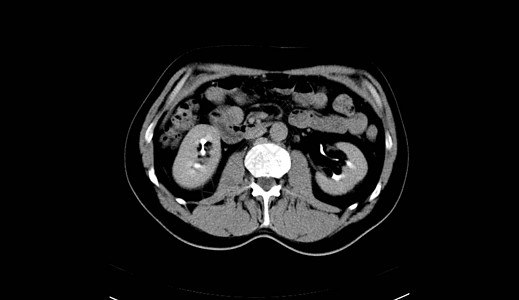 人类腹部人 男人 CT扫描骨盆x光脊柱纸巾考试内脏器官肋骨树干诊断图片