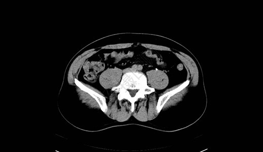 人类腹部人 男人 CT扫描肋骨树干脊柱射线骨盆内脏考试药品x光诊断图片