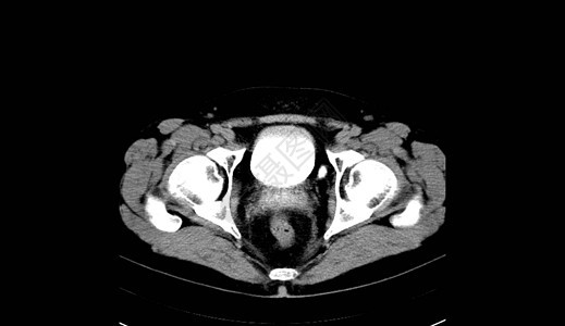 人类腹部人 男人 CT扫描射线器官纸巾诊断脊柱骨盆内脏考试肋骨树干图片