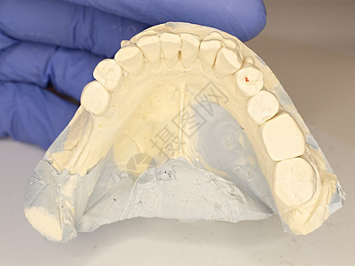 显示病人牙齿腐烂的卡斯特模型诊所牙科生产衰变卫生模具手术树桩石膏外科图片