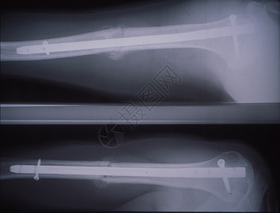 事故发生后钉的骨头X光片辐射骨骼夹板考试医生臂骨药品金属棒照相医院图片