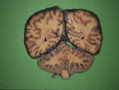 人类大脑被神经切片回旋器官诊断科学横截面颅骨考试药品小脑脊髓图片