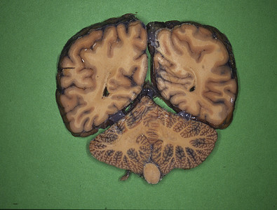 人类大脑被神经切片回旋器官诊断科学横截面颅骨考试药品小脑脊髓背景图片