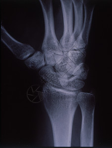 X光图像 男人 手与骨头和关节药品医院休息事故科学诊断x光辐射考试指骨图片