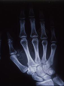 X光图像 男人 手与骨头和关节指骨考试药品医院休息诊断科学医生组织x光背景图片