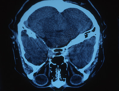 X射线图像中的脑部扫描射线小脑鼻子大脑皮层科学x光头骨考试断层图片