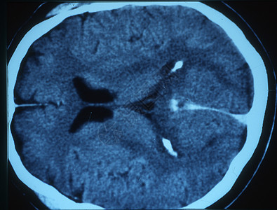X射线图像中的脑部小脑头骨鼻子科学考试x光扫描大脑皮层射线断层图片