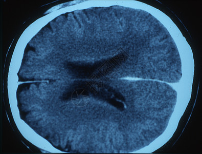 X射线图像中的脑部射线考试头骨小脑断层科学x光大脑皮层鼻子扫描图片