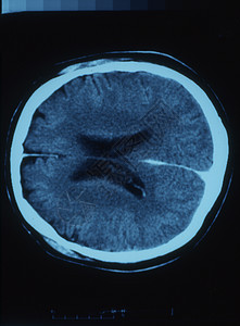 X射线图像中的脑部断层头骨扫描x光小脑大脑皮层射线鼻子考试科学图片