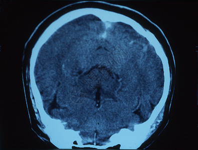 X射线图像中的脑部射线大脑皮层小脑考试断层科学头骨鼻子x光扫描图片