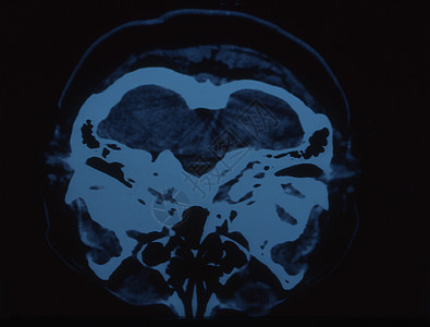 X射线图像中的脑部科学头骨断层小脑鼻子射线扫描x光大脑皮层考试图片
